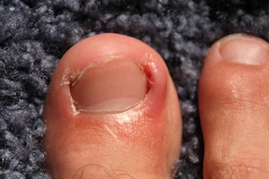 Treating Problematic Ingrown Toenails
