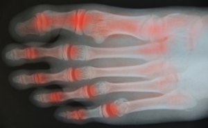 Psoriatic Arthritis and the Feet