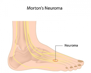 Diagnosing Morton&#039;s Neuroma