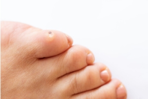 Symptoms, Causes and Risk Factors for Corns
