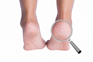 Heel Fissure Causes
