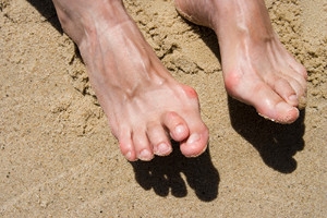 How Footwear Can Lead to Hammertoes