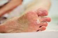 What Are Plantar Warts?