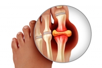 What Can Alleviate Gout Pain?