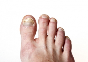 Symptoms and Prevalence of Toenail Fungus