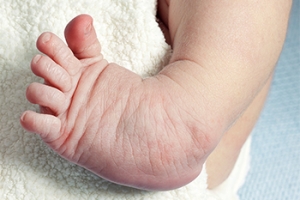 Treatment of Clubfoot