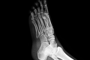 What Is a Metatarsal Stress Fracture?