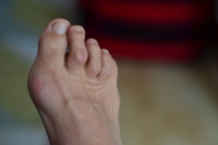 Two Types of Hammertoe and Their Treatments